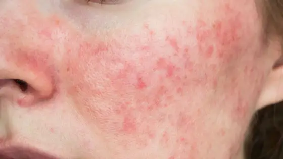 Trądzik bakteryjny - co naprawdę pomaga i kiedy do dermatologa?